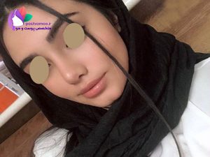 نمونه کار دکتر ساریخانی جراح بینی در شیراز