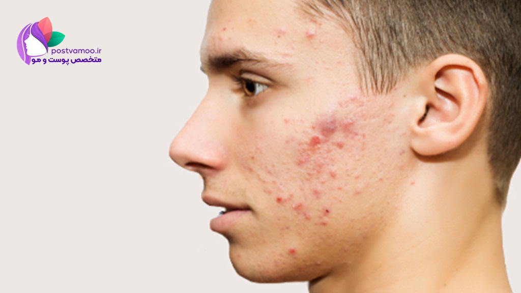 روش های درمان جوش صورت با مواد طبیعی خانگی