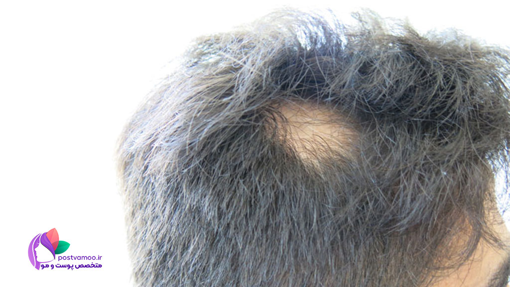علائم ریزش مو سکه ای (آلوپسی آره آتا) چیست؟