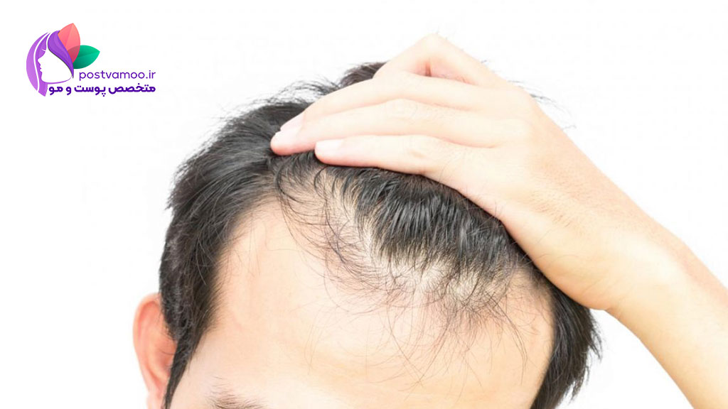 کاشت مو به روش FUT چگونه است؟