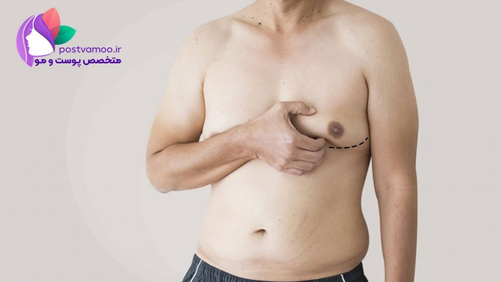 جراحی کوچک کردن سینه مردان در شیراز