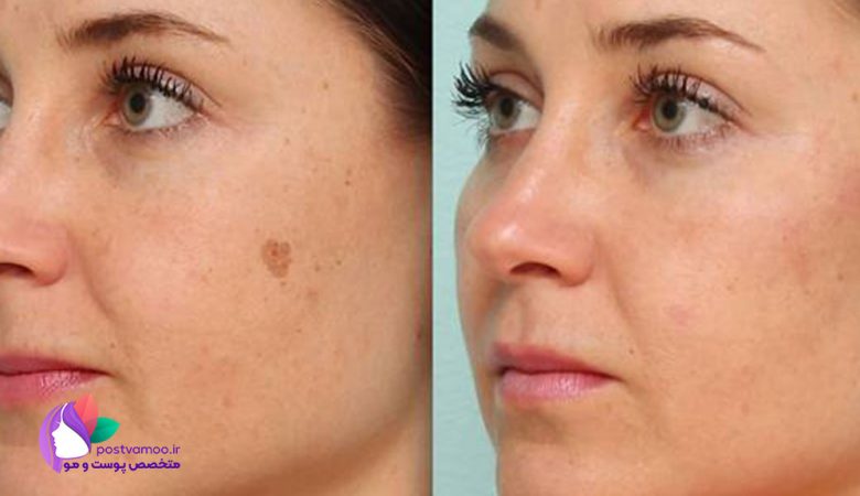 درمان خانگی لک های صورت با 14 تکنیک