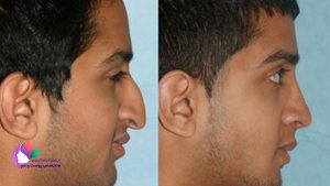 نمونه جراحی بینی مردان