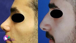 نمونه جراحی بینی مردان