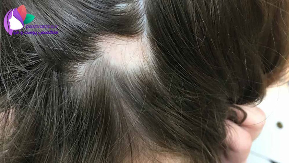 علت ریزش موی سکه ای و بهترین راه درمان آن