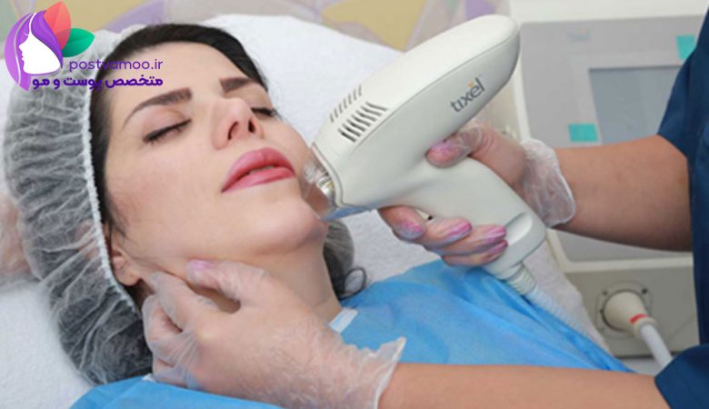 دستگاه تیکسل جدید ترین روش برای از بین بردن لکه پوستی