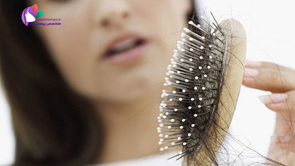 برای جلوگیری از ریزش مو سر چی بخوریم؟