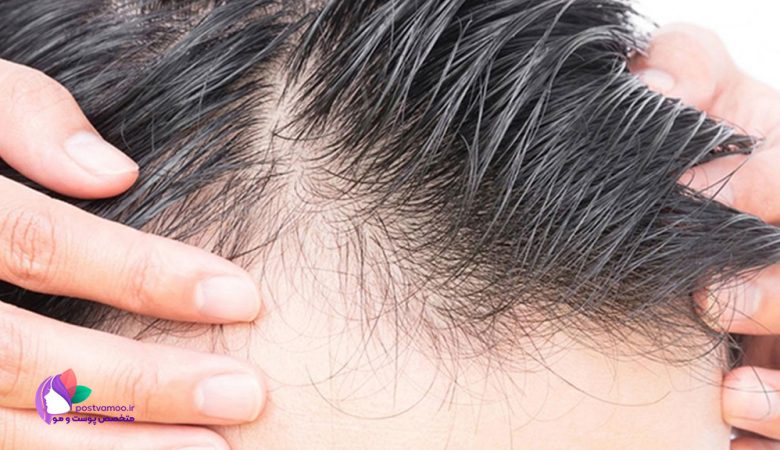 بهترین راه درمان ریزش مو