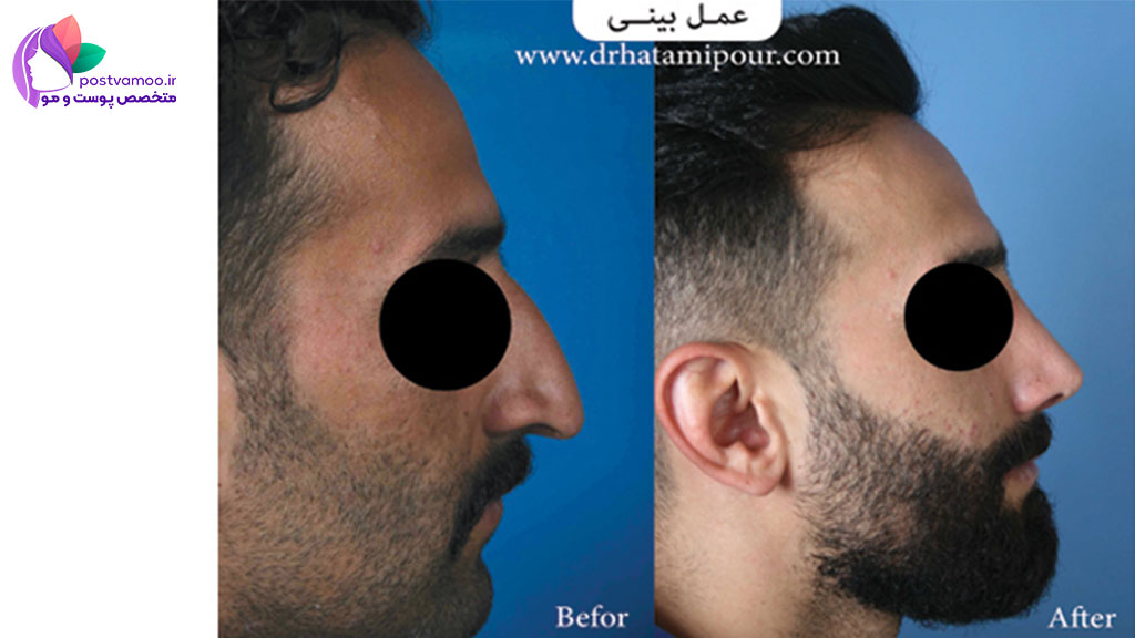 نمونه جراحی بینی توسط دکتر حاتمی پور