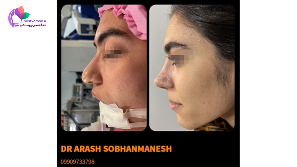 جراحی بینی توسط دکتر سبحان منش در شیراز