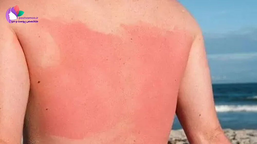 خارش پوست بعد از آفتاب سوختگی