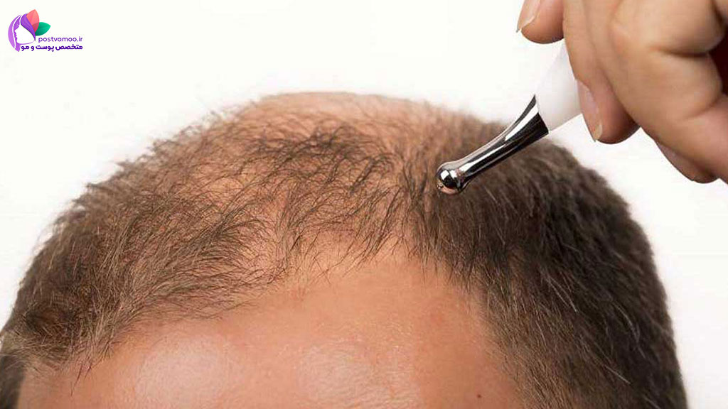 راه های درمان ورم صورت بعد از کاشت مو چیست؟