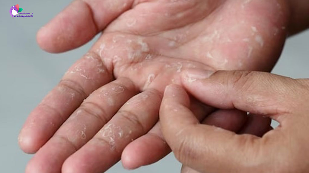 چگونه از پوست پوست شدن دست جلوگیری کنیم؟