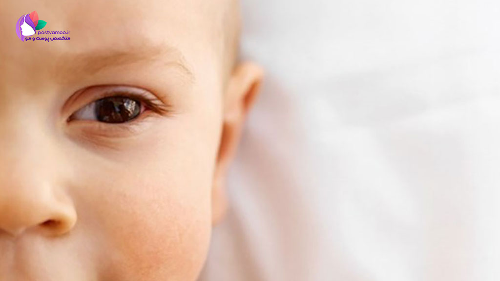 درمان اگزما پوستی نوزادان در طب سنتی