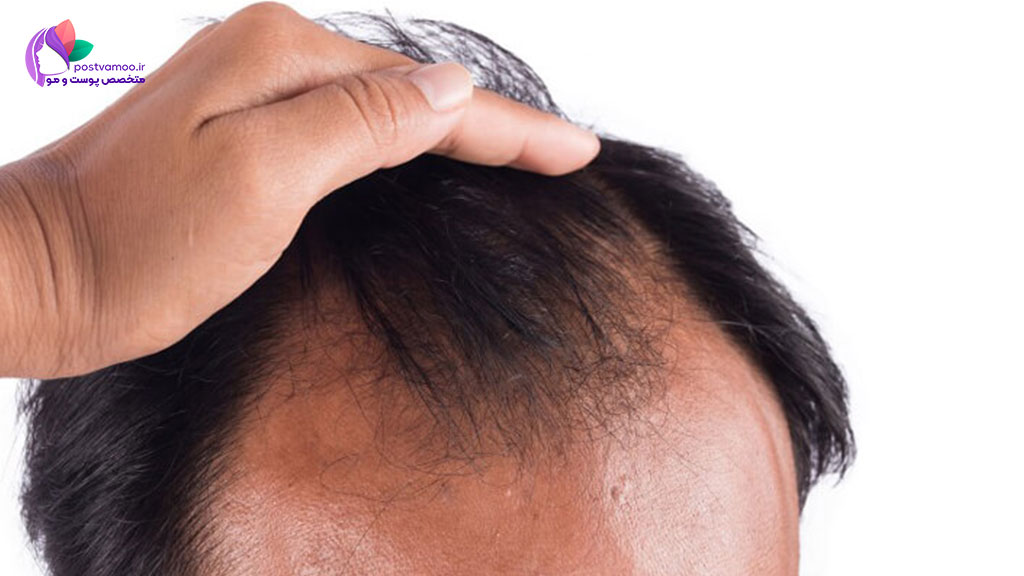 علل ریزش موی ارثی چیست؟