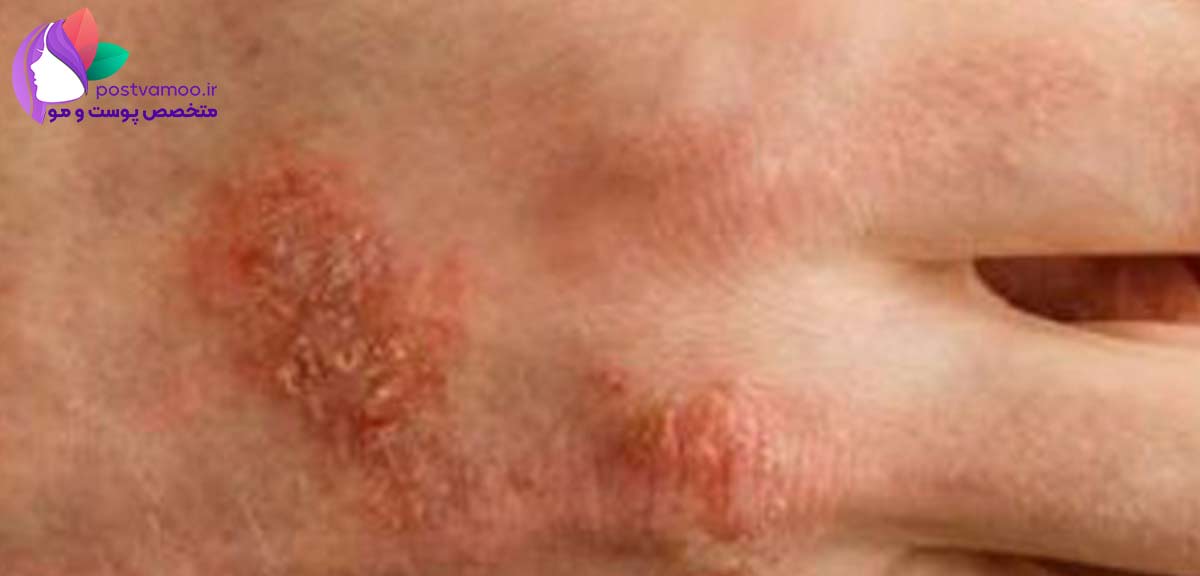 درمان عفونت های پوست