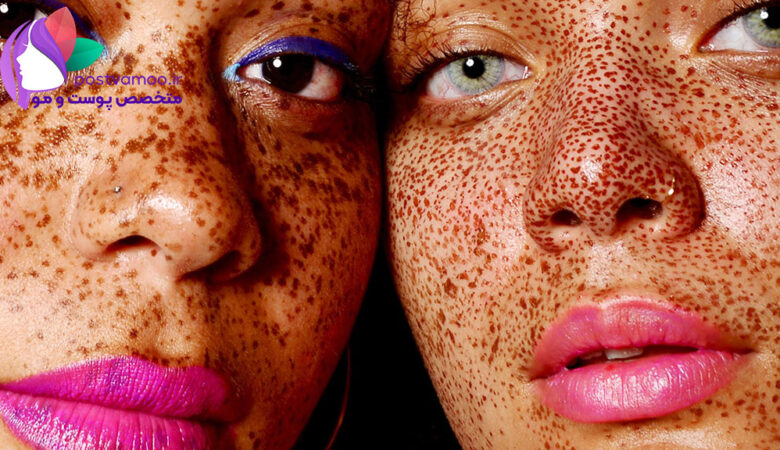 تشخیص اختلالات رنگدانه های پوست