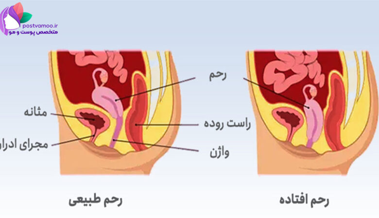 دکتر درمان افتادگی رحم در شیراز