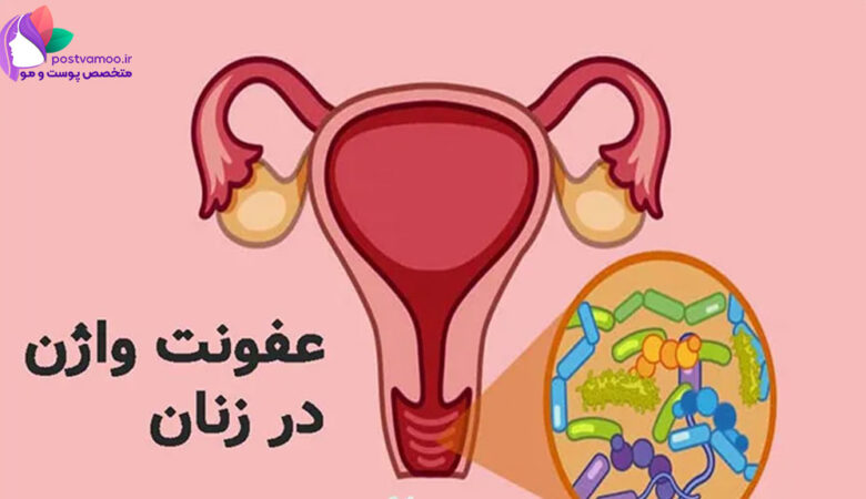 بهترین دکتر درمان عفونت واژن در شیراز